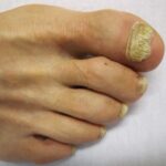 Sole Motion Fungal Nails